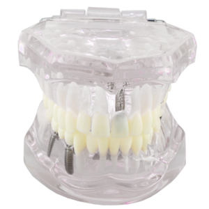 نموذج أسنان تشريحي للغرس السني Dental Implant Anatomy Model
