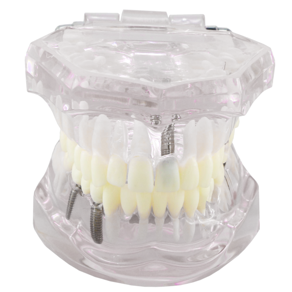 نموذج أسنان تشريحي للغرس السني Dental Implant Anatomy Model